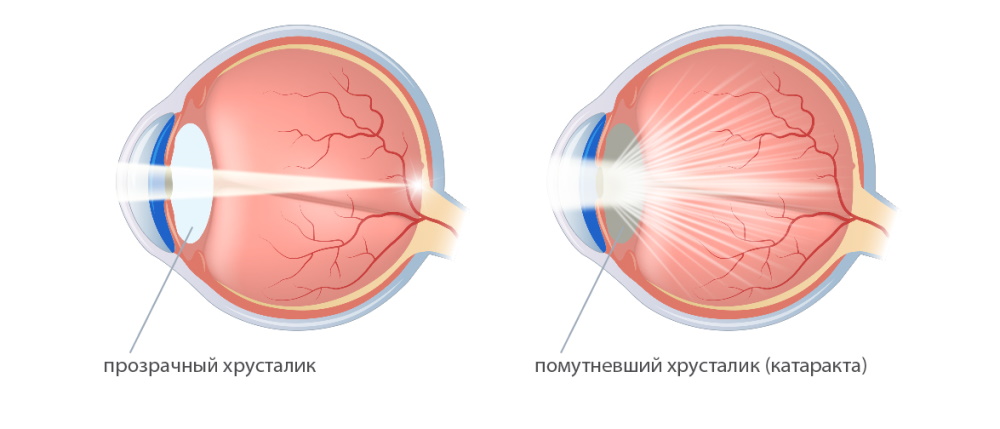 Причины катаракты
