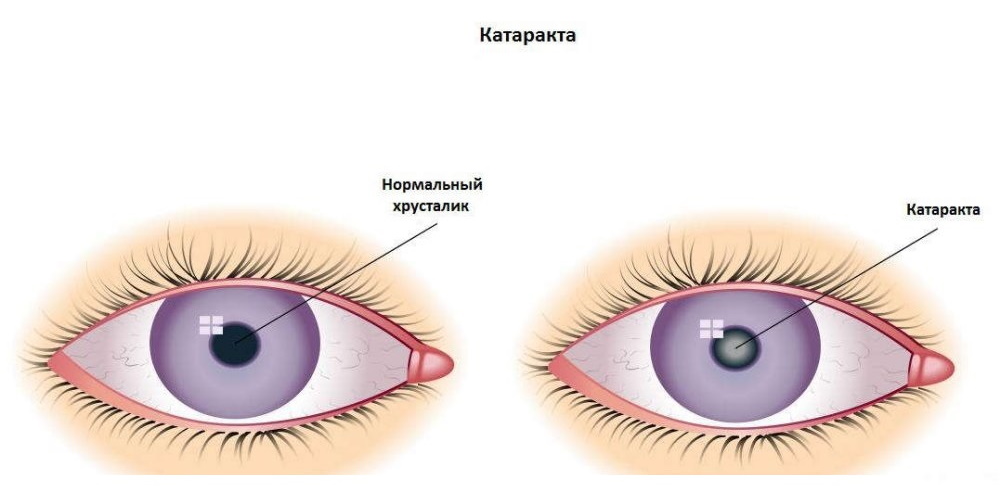 Определение катаракты